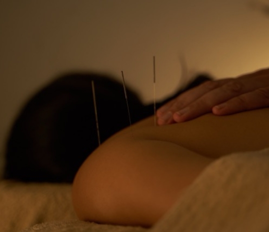 Person receiving acupuncture for anxiety, needles in their back, lying face down on a table.