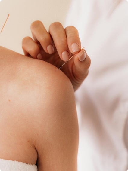 A person inserts an acupuncture needle into another person's shoulder.