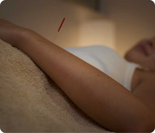 A person lying down with an acupuncture needle inserted into their forearm.