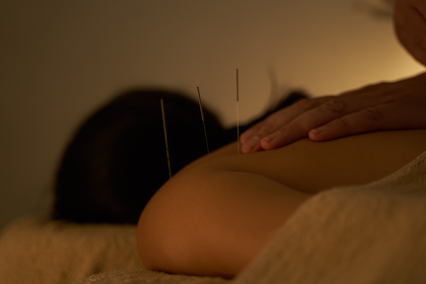A person receiving acupuncture, with needles in their back and a hand resting on their shoulder.
