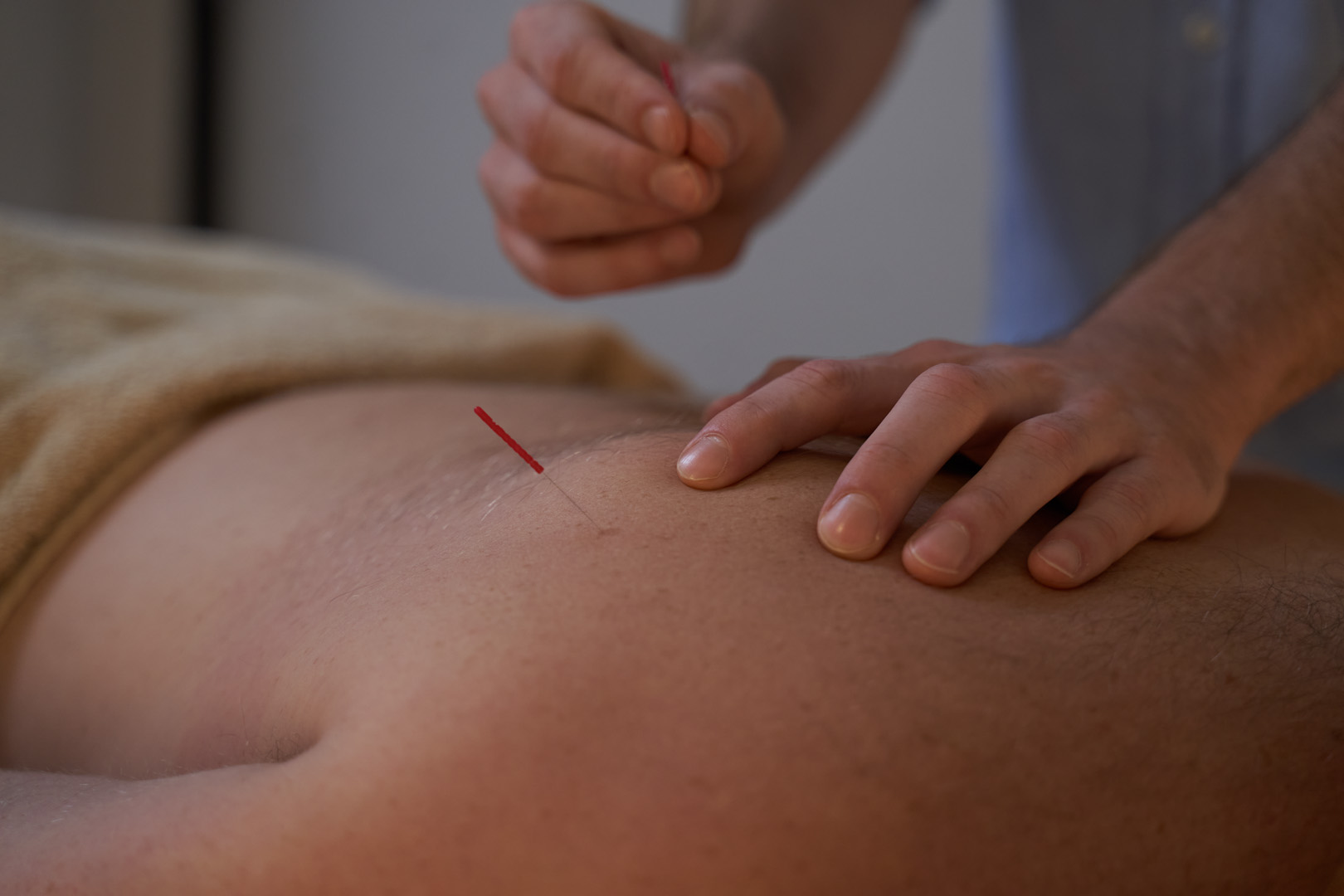 A person receives acupuncture, a key practice in TCM, with a thin needle in their bare back.