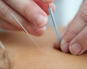 Image explaining electro-acupuncture
