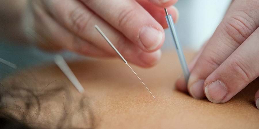 Close-up of hands inserting acupuncture needles, a key technique in TCM healing practices.