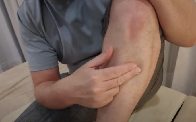 A person points to a bruised lower leg, considering acupuncture for relief.