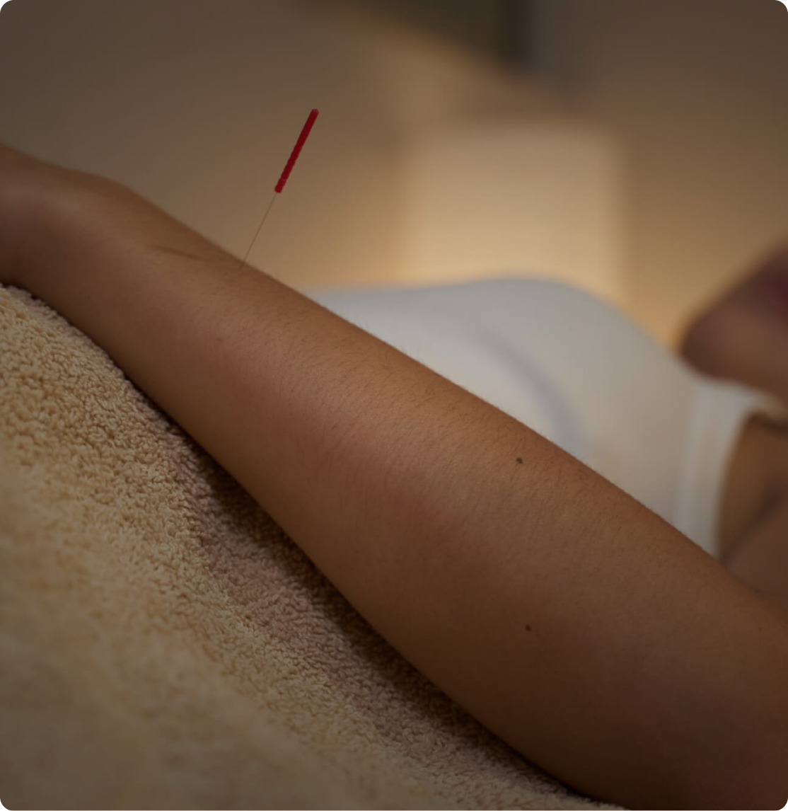 A person’s arm with an acupuncture needle inserted, showing a classic TCM therapy session.